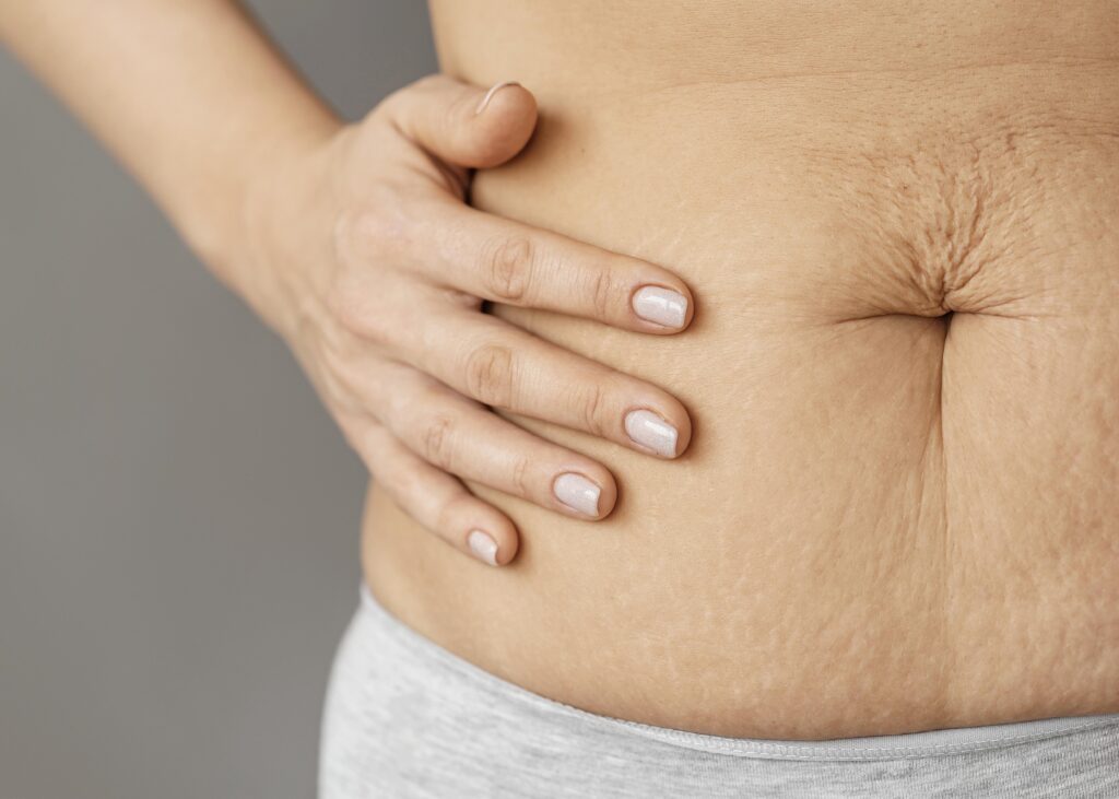 Lexique complet sur l’abdominoplastie