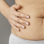 Lexique complet sur l&rsquo;abdominoplastie